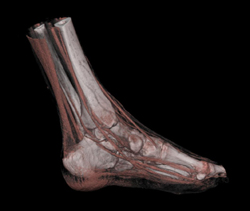 Cellulitis - CTisus CT Scan