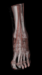 Cellulitis - CTisus CT Scan