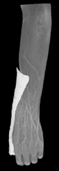 Cellulitis Without Abscess - CTisus CT Scan