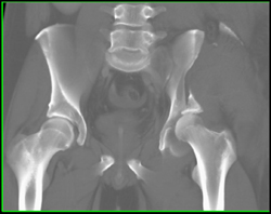 Iliac Wing Fracture Extends Into the Acetabulum With Hip Dislocation - CTisus CT Scan