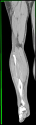 No Evidence of Deep Vein Thrombosis (DVT) - CTisus CT Scan