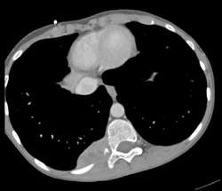 Neurofibromatosis With Sarcoma - CTisus CT Scan