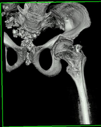 Osteogenesis Imperfecta - CTisus CT Scan