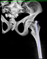 Osteogenesis Imperfecta - CTisus CT Scan