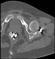 Osteogenesis Imperfecta - CTisus CT Scan