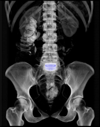 Fusion at L5-s1 - CTisus CT Scan