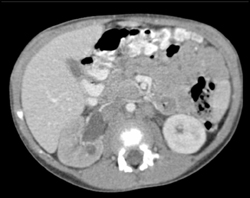 Hip Joint Effusion - CTisus CT Scan