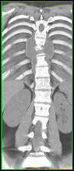 Osteomyelitis With Vertebral Collapse - CTisus CT Scan