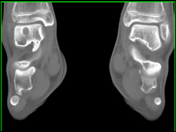 Cyst in Talus - CTisus CT Scan