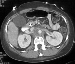 Lymphoma Involves Spine - CTisus CT Scan