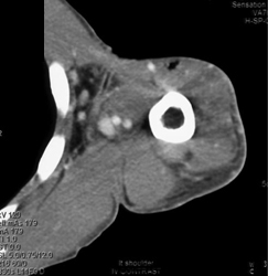 Cellulitis - CTisus CT Scan