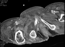 Infected Hip Joint With Osteomyelitis - CTisus CT Scan