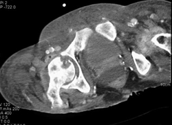 Osteomyelitis - CTisus CT Scan