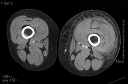 Cellulitis - CTisus CT Scan