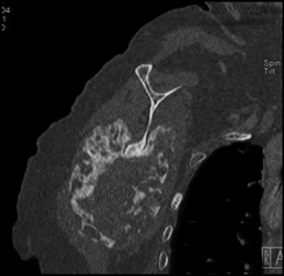 Chondrosarcoma - CTisus CT Scan