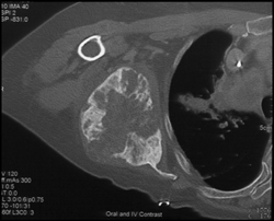 Chondrosarcoma - CTisus CT Scan