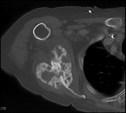 Chondrosarcoma - CTisus CT Scan