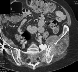 Metastatic Disease to Iliac Wing - CTisus CT Scan