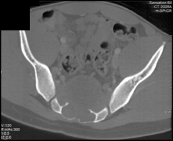 Chordoma - CTisus CT Scan