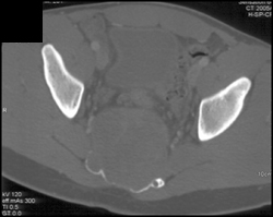 Chordoma - CTisus CT Scan