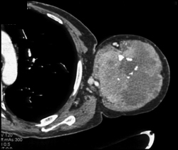 Lung Cancer Metastatic to the Humerus - CTisus CT Scan