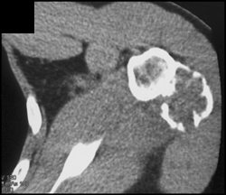 Chondrosarcoma - CTisus CT Scan