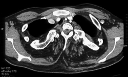 Fatty Infiltration of the Muscle - CTisus CT Scan