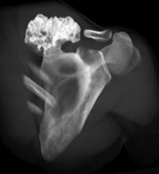 Exostosis - CTisus CT Scan