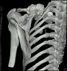 Exostosis - CTisus CT Scan