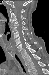 Osteomyelitis - CTisus CT Scan