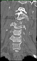 Osteomyelitis - CTisus CT Scan