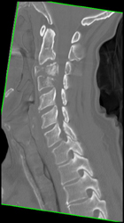 Osteomyelitis - CTisus CT Scan