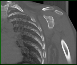 Scapular Fracture - CTisus CT Scan