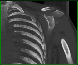 Scapular Fracture - CTisus CT Scan