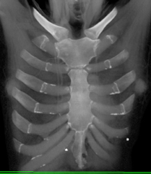 Normal Costal Cartilage Junction - CTisus CT Scan