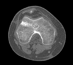 Post Repair of Femur - CTisus CT Scan