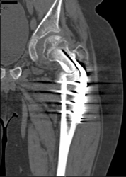 Nonunion Femur - CTisus CT Scan