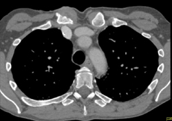 Inflammation of Right S/c Joint - CTisus CT Scan