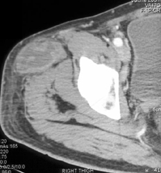 Abscess - CTisus CT Scan