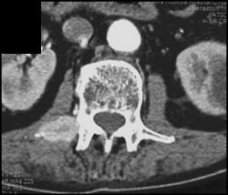 Metastatic Islet Cell Tumor - CTisus CT Scan