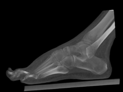 Bone Editing Tool - CTisus CT Scan