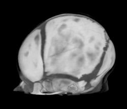 Cranial Sutures With Different Renderings - CTisus CT Scan