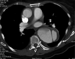 Aortic Dissection - CTisus CT Scan