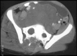 Neurofibromatosis - CTisus CT Scan