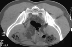 Radiofrequency Ablation (RFA) of An Osteoid Osteoma - CTisus CT Scan