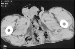 Necrotizing Fasciitis - CTisus CT Scan