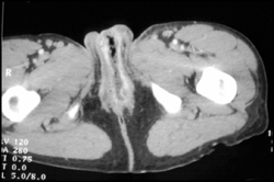 Necrotizing Fasciitis - CTisus CT Scan