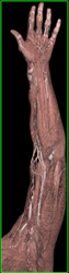 Patent Shunt for Dialysis - CTisus CT Scan