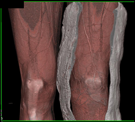 CTA With Bone Removal Defining the Vessels - CTisus CT Scan