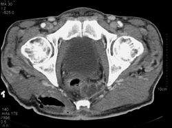 Necrotizing Fasciitis - CTisus CT Scan